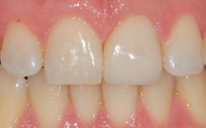 Vancouver Cosmetic Dentistry After Crown