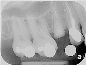 West Broadway Dental Implants Esthetic