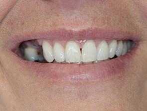 West Broadway Dental Implants Patient