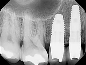 Van Dental Clinic Esthetic Implant Imaging