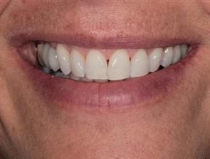 Patient After Dental Implant Procedure