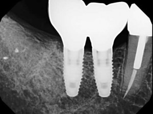 West Broadway Dental Implant Imaging