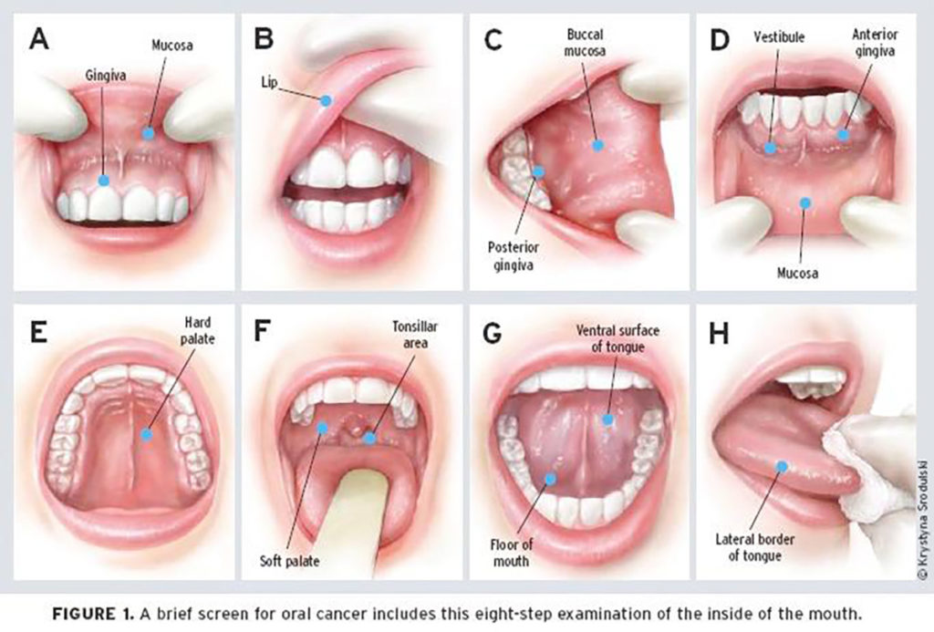 oral cancer screening