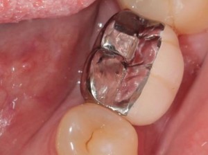Van Dental Clinic Dental Implants
