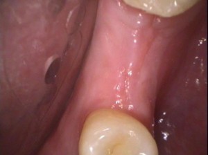 Van Dental Clinic Before Dental Implant