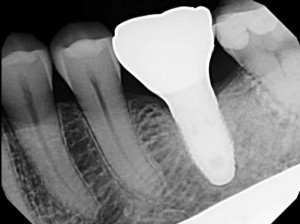 West Broadway Dental Implants