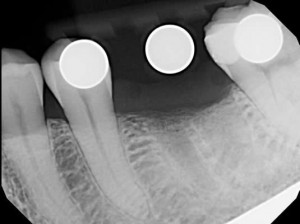 Dental Implant Imaging